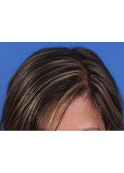 After Hair Transplant&nbsp;Hair Thinning